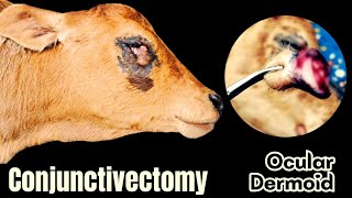 Conjunctivectomy  Dr Md Abu Bakar Ahad [upl. by Asseret472]