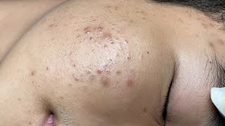 ACNE TREATMENT VU QUYNH MI  Blackheads On Boy Face 2024FULL [upl. by Randolph]