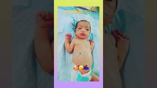 tracheoesophageal fistulanicu nicubaby viralvideo shorts 😍😍🥰🥰😘😘😘 [upl. by Joanne]