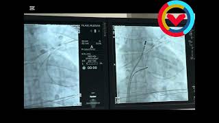 Carto 3 sistemi ile VPS ablasyonu VES [upl. by Ahsinroc616]