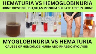 HOW TO DIFFERNTIATE HEMATURIA VS HEMOGLOBINURIA VS MYOGLOBINURIACAUSES URINE DIPSTICKLDH AND CK [upl. by Akimrehs]