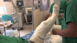 Attelle plâtrée pour une fracture du tibia cruropédieuse [upl. by Lundquist]