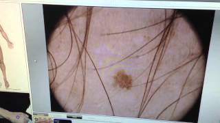 microfinder  microderm dermoscopy  diagnosis [upl. by Glennis]