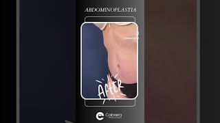 Abdominoplastia [upl. by Blaire]