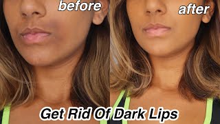 How To Get rid Of Dark Lips And Pigmentation [upl. by Forkey]