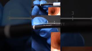 Full Episode on channelAwake intubation anesthesia intubation anesthesiology [upl. by Corsiglia49]