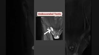 Undescended Testis MRI shorts viral youtubeshorts mrincredible [upl. by Urbai]