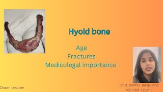 Hyoid bone Age Types of fractures Medicolegal importance  Forensic Medicine [upl. by Annawik]