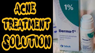 DermaT Clindamycin phosphate Topical Solution  How to get rid Acne  ACNE TREATMENT UPDATE [upl. by Akenet]