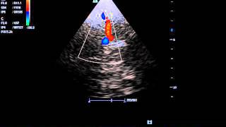 transcranial doppler in patient with hyperdynamic circulation due to anemia [upl. by Hbaruas530]