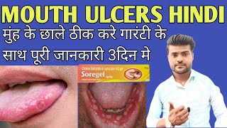 How do you use SoregelWhich gel is best for mouth ulcerWhat is choline salicylate used for [upl. by Dede]