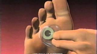 Dr Scholls Commercial 1996 Callus Removers Cushlin Advanced Pain Relief [upl. by Kcyred]