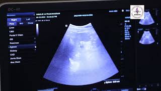 Ultrasound of Gallbladder Spleen Pancreas By Dr Sharmin AKHTER Teacher BIMDUR PRIVATE LIMITED [upl. by Giacinta]