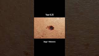 Melanoma Skin Cancer Development Time Lapse Normal to Stage 4 Melanoma Over 10 Years [upl. by Yelserp]