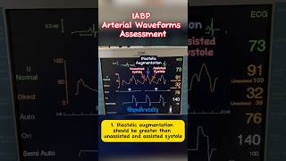 IABP Arterial Waveform Assessment cardiology criticalcare cathlab [upl. by Aerahs47]