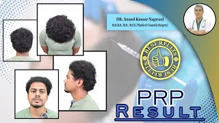 PRP Result  PRP Therapy for Hair Fall  PRP Treatment stop hair fall  Hair Fall Solution [upl. by Elbag]