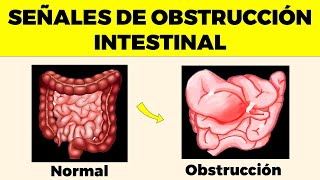 OBSTRUCCIÓN INTESTINAL Señales de Alerta Que Nunca Debes Ignorar [upl. by Heurlin]