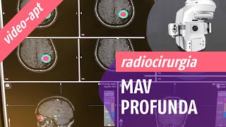 Radiocirurgia para MAV profunda [upl. by Syah]