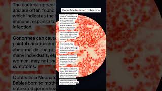 Neisseria gonorrhoeae is bacteria for gonorrhea sexually transmitted infection microbiology [upl. by Yticilef931]