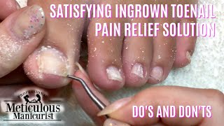 Ingrown vs Impacted Toenail Mr Meticulous [upl. by Eiramnwad526]