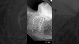 Mandibular Third molar with severe curvature molar rct  short curvature endodontics [upl. by Lavina]