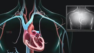 Cardiac Ablation Procedure Risks and Recovery [upl. by Shaya]