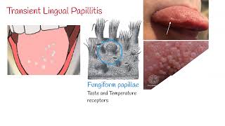 Transient lingual papillitis Lie Bumps  Inflammation of the tongue [upl. by Bramwell]