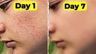 7 Days Clear Skin Challenge With Home Remedies  Clear Tiny Bumps from Forehead amp Face [upl. by Wallach]