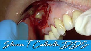 Apicoectomy with Bone Graft and Membrane  with Steven T Cutbirth DDS [upl. by Paolina802]