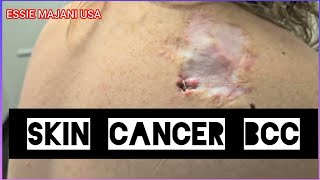 Skin Cancer misdiagnosed Basal Cell Carcinoma 😞😢 [upl. by Liagibba]