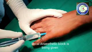 PIP joint Dislocation  Little finger injuries  Polytrauma  Adamya Hospital Videos [upl. by Anirad]