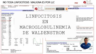 LINFOCITOSIS HEMOGRAMA EN CASO DE MACROGLOBULINEMIA DE WALDESTROM [upl. by Nedra872]