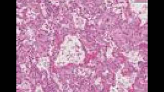 Histopathology LungDiffuse alveolar damage adult respirat [upl. by Haimehen]