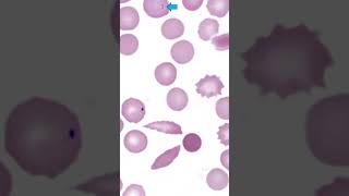 Pappenheimer Bodies amp HowellJolly Bodies in Sickle Cell Anemia patient Blood Smear Hematology [upl. by Britta]