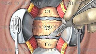 2 Level Cervical Arthrodesis with ProDiscC [upl. by Faxan]