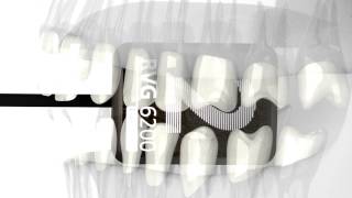 Bitewing Horizontal Premolar [upl. by Atteloj]