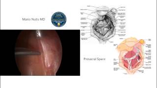 Laparoscopic Presacral Neurectomy [upl. by Brook]