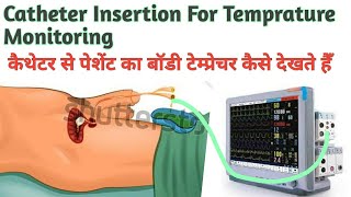 Foley Catheter insertion For Temprature Monitoring  फोली कैथेटर से पेटेंट का बॉडी टेम्प्रेचर [upl. by Orihakat]