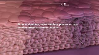 Solución Roche para la prevención de Cáncer Cervical [upl. by Fleming]