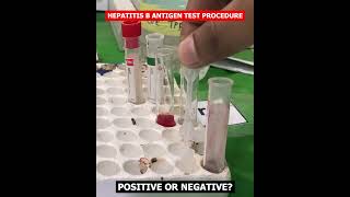 HBsAg test  Hepatitis B virus  Hepatitis B surface antigen test science labtest [upl. by Enenaj]