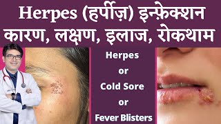 Herpes Infection Of Skin  हर्पीज़ के कारण लक्षण इलाज  Herpes Symptoms Causes Treatment  Hindi [upl. by Carlick472]