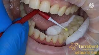 Stomatologie ChisinauBotanicaTerraDentCoroane dentare din Ceramica cu suport ZIRCONIU PE IMPLANT [upl. by Elleirb]