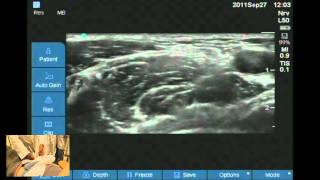 Ultrasound Guided Femoral and Lateral femoral cut nerve workshop [upl. by Nallak]