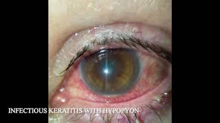 INFECTIOUS KERATITIS WITH HYPOPYON [upl. by Feola]