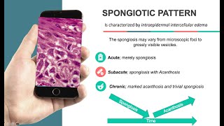 Spongiosis Reaction pattern [upl. by Kera]