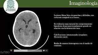 Cordomas del Clivus Neurocirugia Ruben Ramirez [upl. by Abelard]