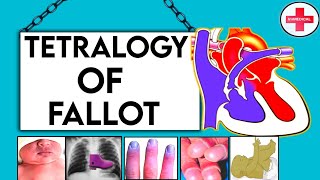 Tetralogy of Fallot TOF pathophysiology causes symptomsdiagnosis and treatment complications [upl. by Aisyram678]