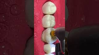 Small Cavity Big DAMAGE rootcanaltreatment [upl. by Acebber956]