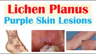 Lichen Planus “Purple Skin Lesions”  Causes Signs amp Symptoms Diagnosis Treatment [upl. by Runkel]