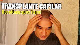 1 Ano após o transplante capilar resumo da caminhada [upl. by Aynodal]